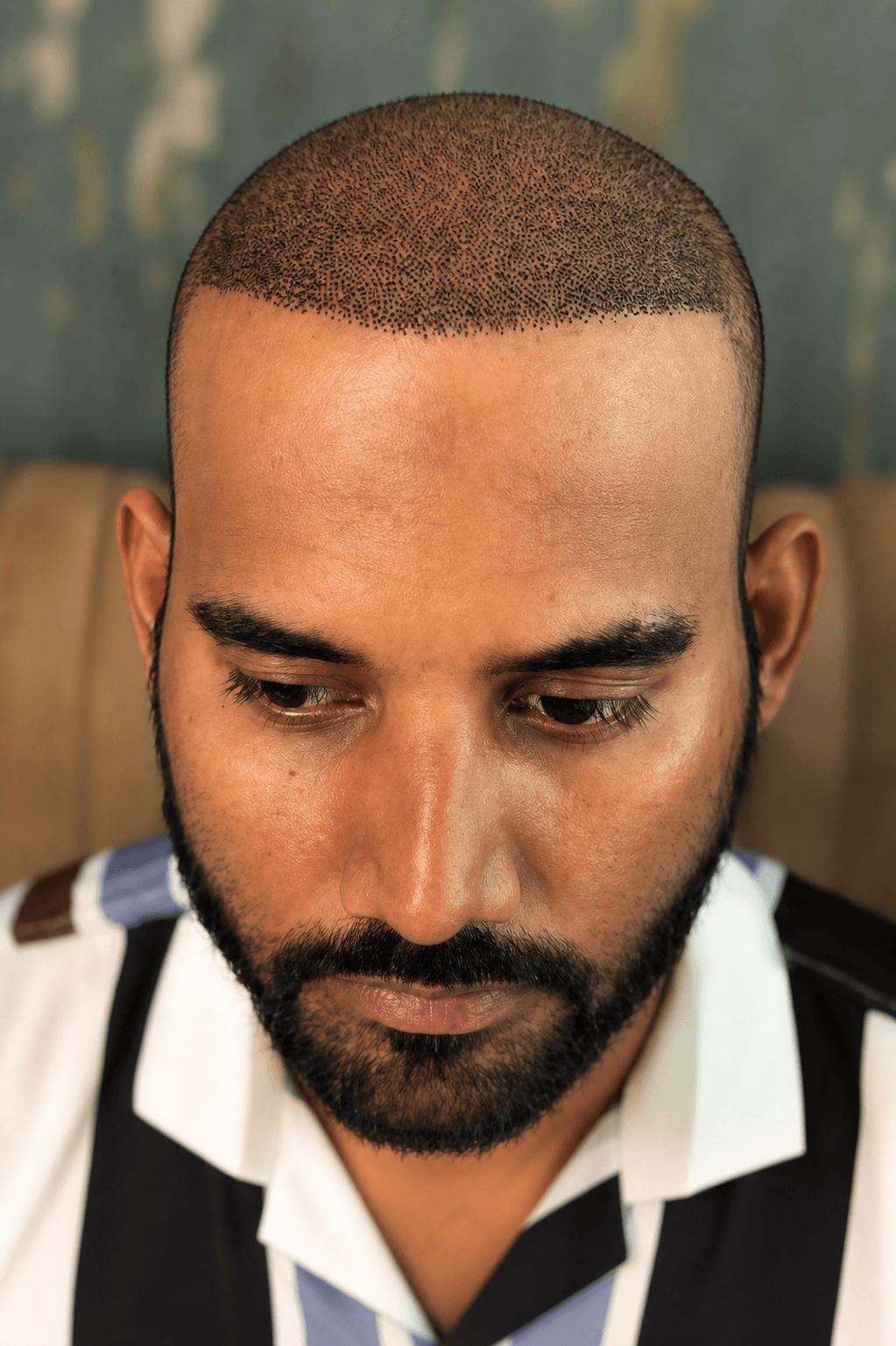 Hair Transplant — FKT Aesthetics