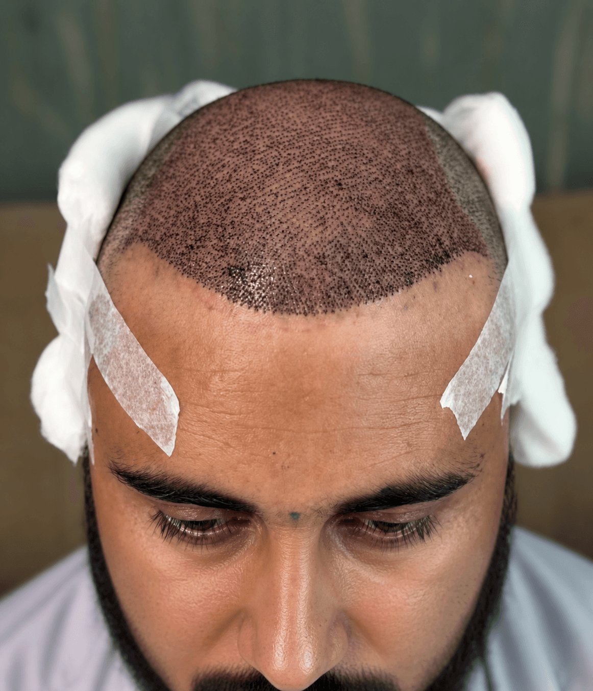 Hair-transplant procedure detail